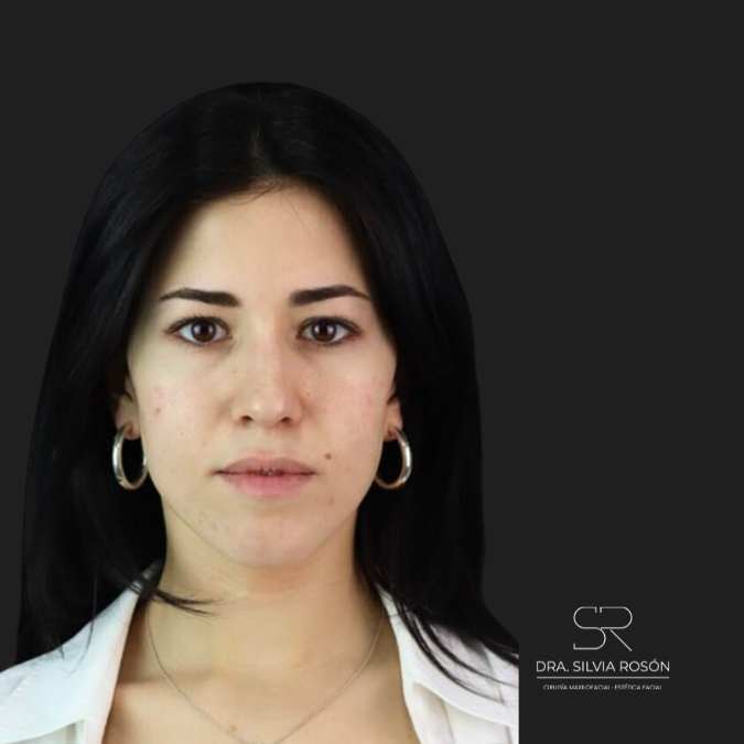 Imagen del estado nasal antes de una rinoplastia en Madrid, Dra. Rosón.