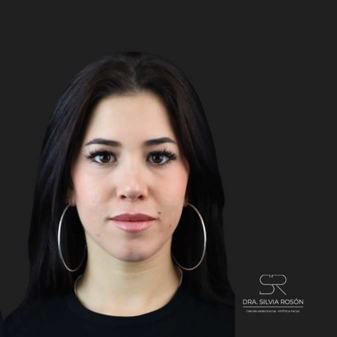 Imagen del resultado después de una rinoplastia en Madrid, Dra. Silvia Rosón.
