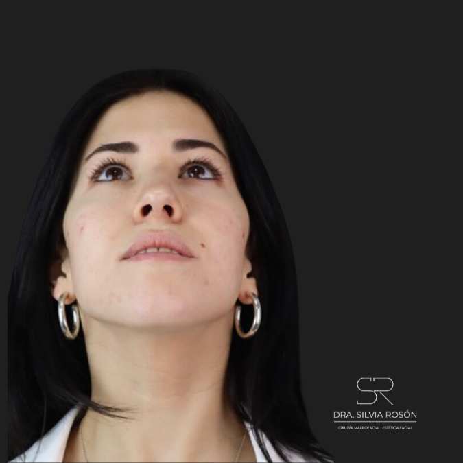 Foto del paciente antes de una rinoplastia en Madrid, Dra. Rosón.