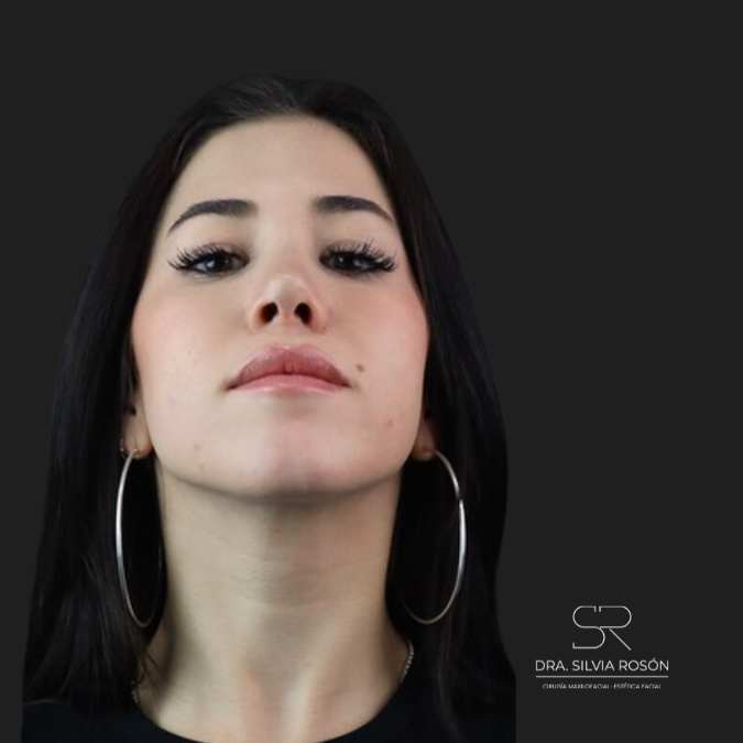 Foto del paciente después de una rinoplastia en Madrid, Dra. Rosón.