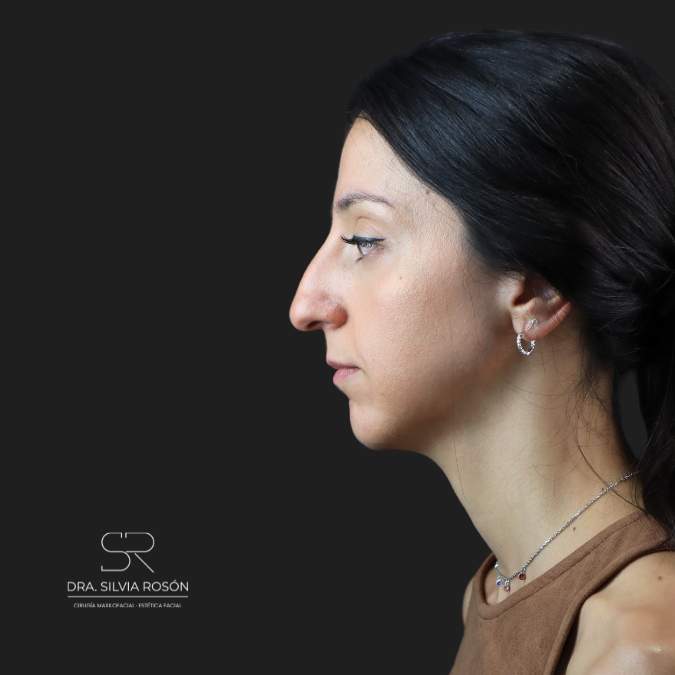 rinoplastia primaria