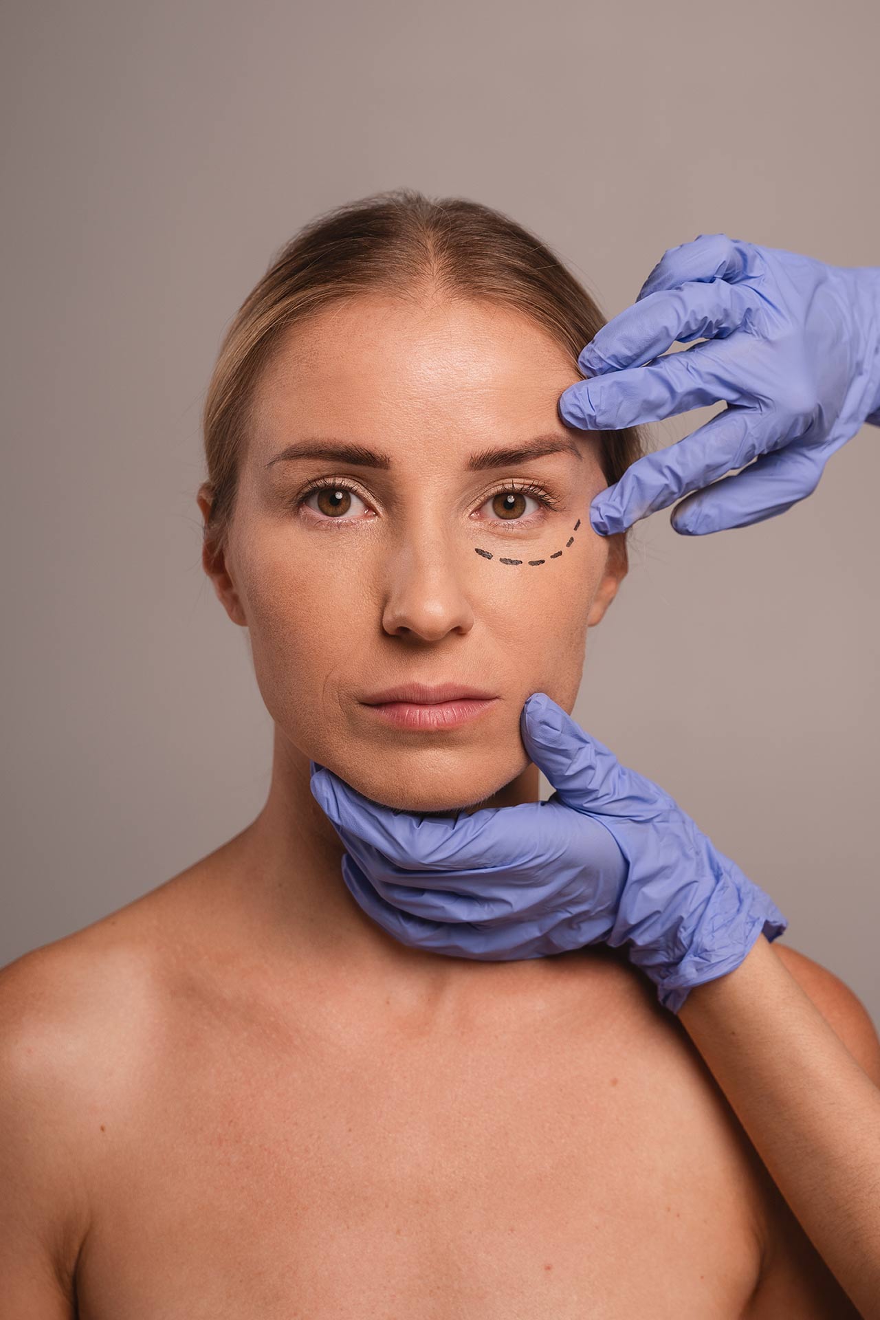 Cirugía de Lifting Facial en Madrid realizada por la Doctora Silvia Rosón, especialista en cirugía maxilofacial y ortognática.
