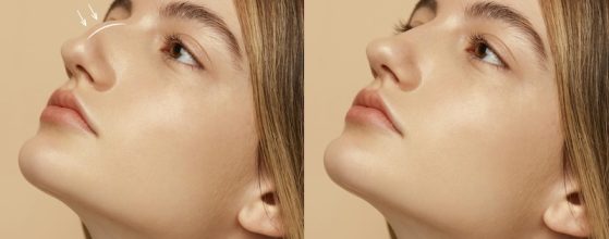 Rinoplastia para corregir el tabique desviado
