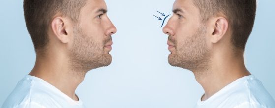 Rinoplastia para hombres: Todo lo que debes saber