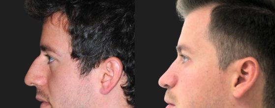 riesgos en la Rinoplastia