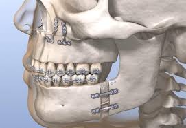 ¿Qué es la mandíbula retraída y cómo se corrige? Un enfoque desde la cirugía maxilofacial