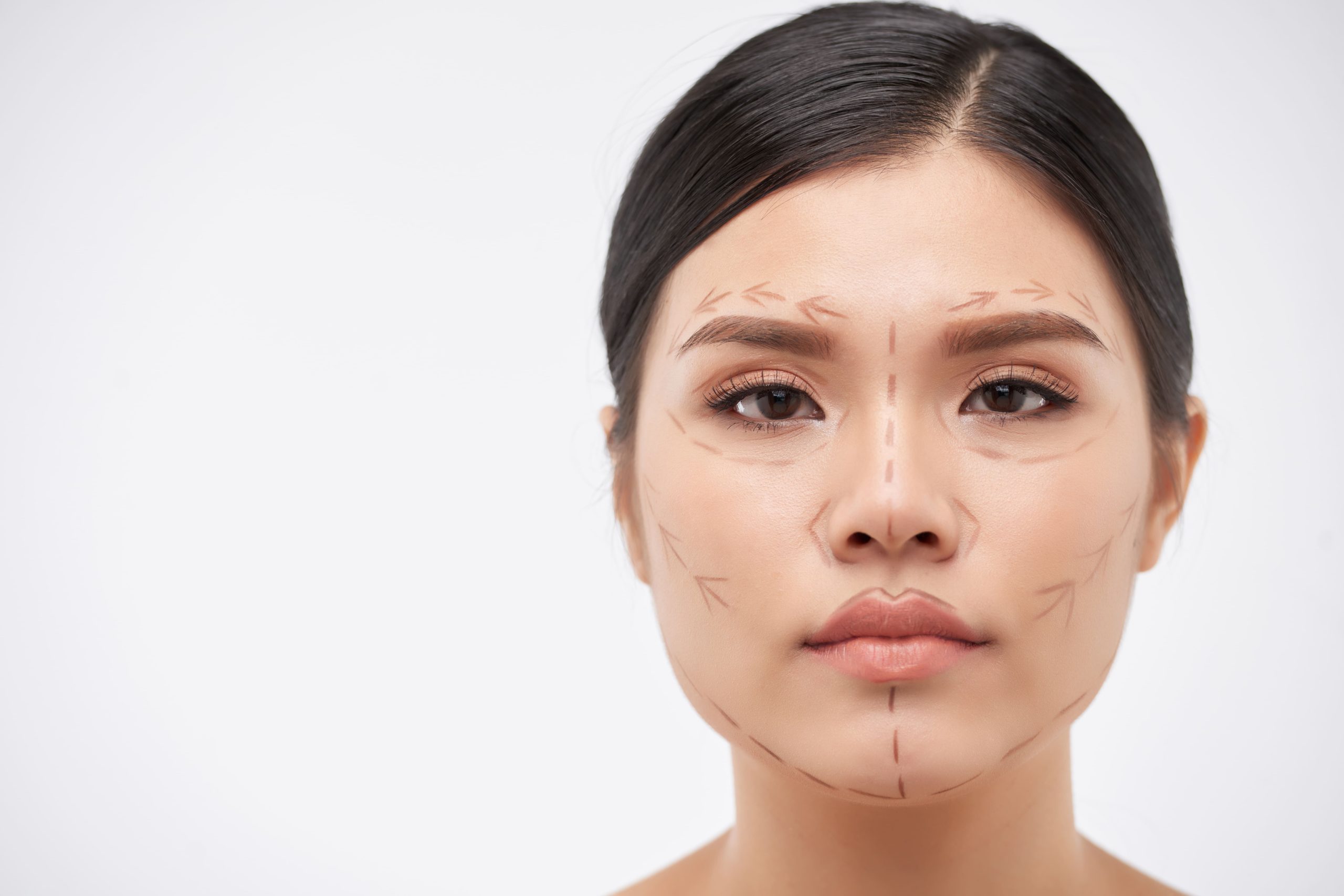 Reposicionamiento 3D para corregir la asimetría facial severa y lograr un rostro armónico