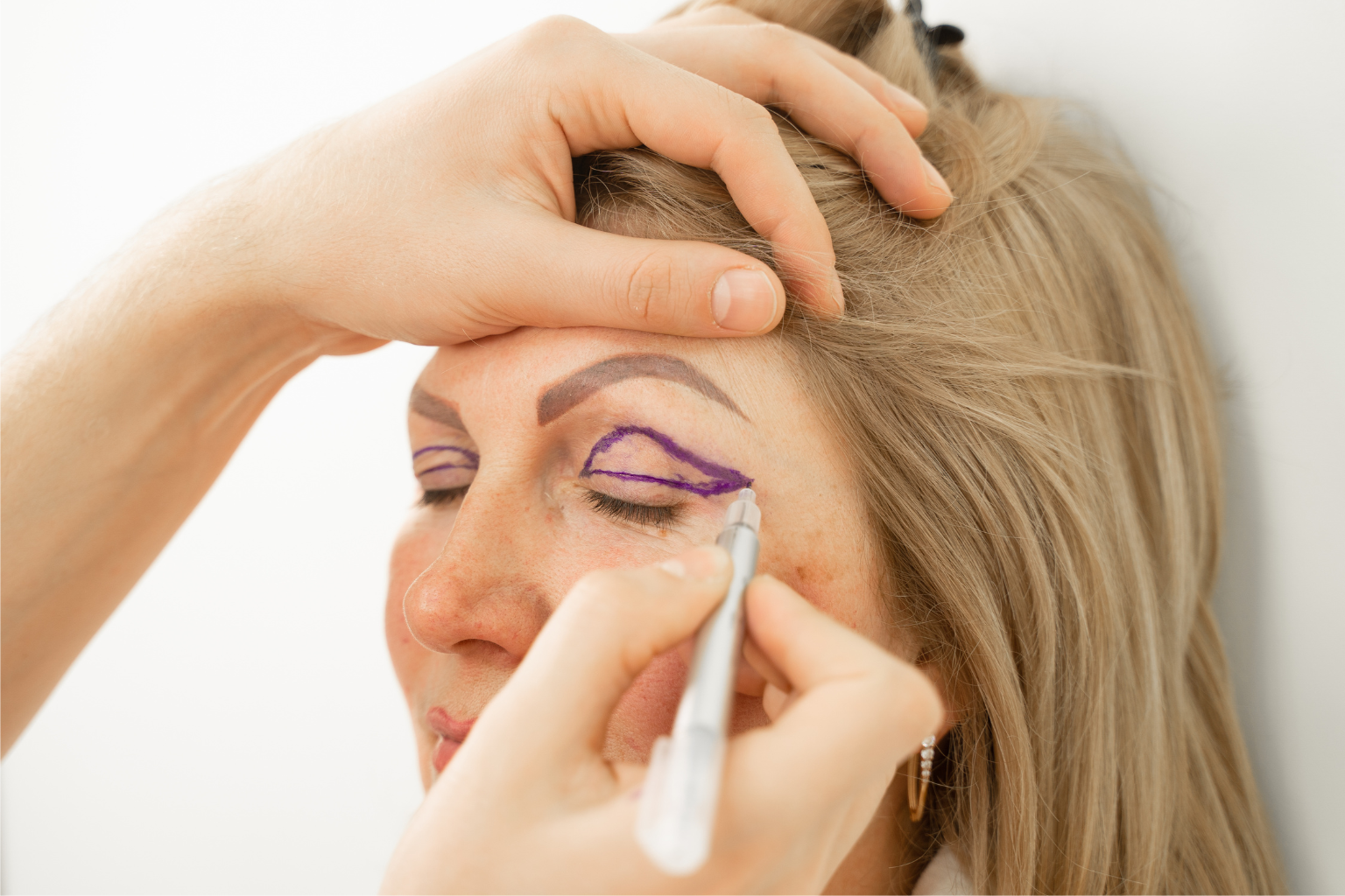 Blefaroplastia funcional: Condiciones médicas solucionadas con la cirugía de párpados