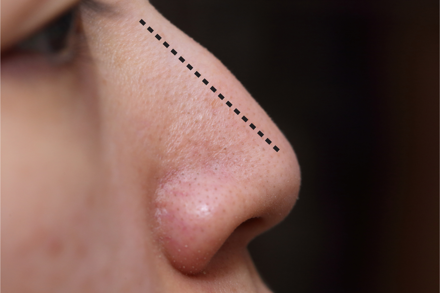 Rinoplastia masculina: El equilibrio entre carácter, armonía y naturalidad