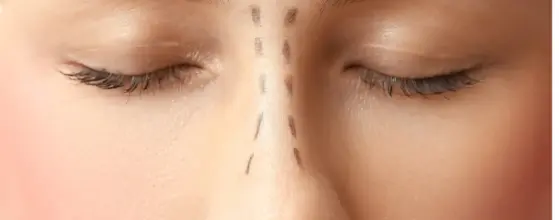 Injertos de cartílago en rinoplastia reconstructiva