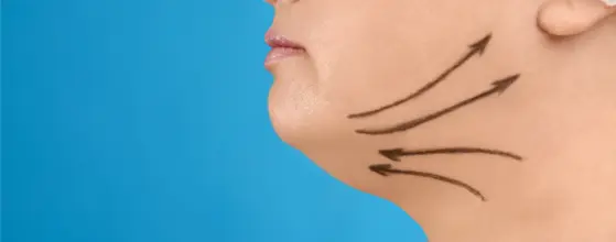 Liposucción submentoniana y tensado de cuello: Adiós a la papada sin piel sobrante