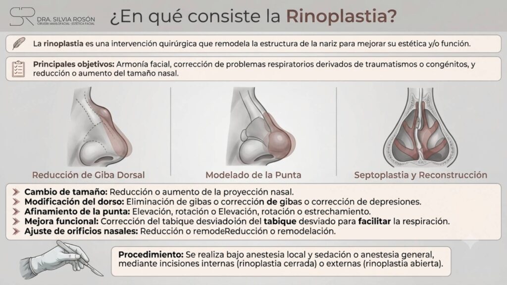 Infografía explicativa de en qué consiste la rinoplastia: reducción de giba dorsal, modelado de la punta, septoplastia y ajuste de orificios nasales