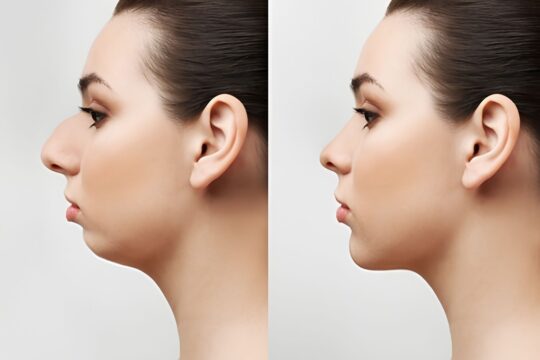 Perfiloplastia: cómo saber si el problema es tu nariz, tu mentón o los dos